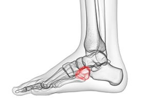 Cuboid Bone Displacement