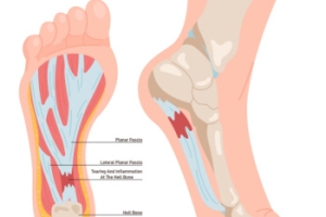 Definition and Risk Factors of Chronic Plantar Fasciitis