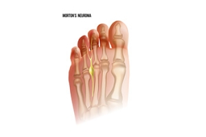 How Cycling Can Contribute to Morton&#039;s Neuroma