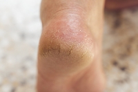 Exploring the Root Causes of Cracked Heels