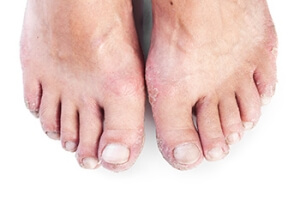 Is It Foot Fungus or Psoriasis?