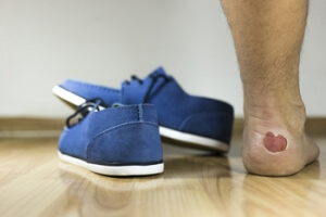 Blisters and Hot Pavement