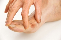 Why Do I Have a Bunion?