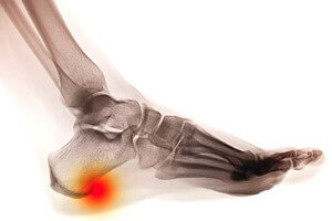 What Causes Heel Spurs?
